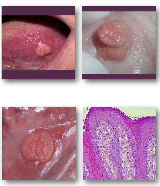 <ul><li><p><strong>Well-defined sessile lesion with rough surface</strong></p></li></ul><p>• Color ranges from <strong>white to yellow or red</strong></p><p>• Usually <strong>small </strong>and less than 2 cm</p><p>• <strong>Common on gingiva and alveolar mucosa</strong></p><p>• <strong>May mimic papilloma or carcinoma</strong></p><p><strong>NOT VIRAL, COMMON ON GINGIVA AND ALVEOLAR MUCOSA </strong></p><p></p>