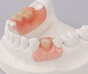 <p>RPD with plastic dento-alveolar clasps</p><ol><li><p>abutment teeth mobility I-II degree</p></li><li><p>caries resistant teeth</p></li><li><p>retentive alveolar ridge</p></li><li><p>esthetics - priority</p></li></ol><p></p>