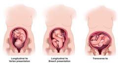 <p>- relation of fetal long axis to the maternal axis</p><p>- longitudinal mc</p>