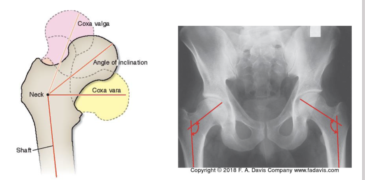 <p><strong>Def: </strong>Angle btw shaft &amp; neck of femur</p><ul><li><p><strong>Coxa valga</strong> = angle in medial side <strong>increased</strong></p><ul><li><p>vertical btw shaft &amp; neck (180 dg) </p></li></ul></li><li><p><strong>Coxa vara</strong> = angle in medial side <strong>reduced</strong></p></li></ul><p></p>