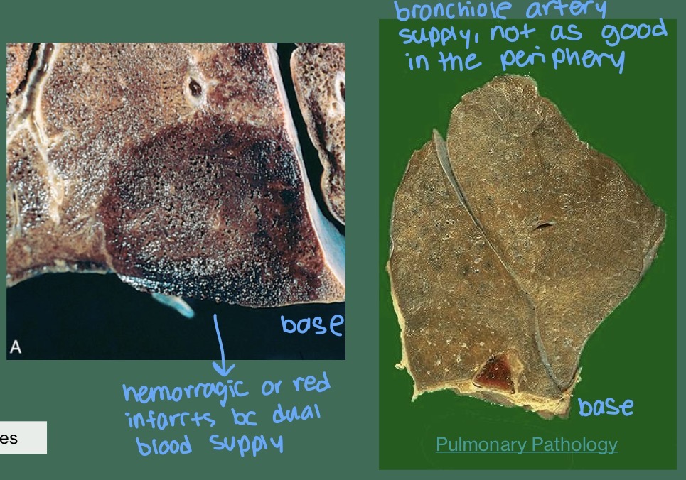 <ul><li><p><span style="background-color: transparent;"><strong>Gross:</strong> <strong>Wedge-shaped</strong> lesion with the base pointing toward the outer edge (pleura).</span></p></li><li><p><span style="background-color: transparent;"><strong>Type:</strong> <strong>Red (Hemorrhagic) Infarct</strong>. Because the bronchial arteries are still pumping some blood into the area, the dead tissue gets soaked in blood.</span></p></li><li><p><span style="background-color: transparent;"><strong>Histology:</strong> Necrosis (death) of the alveolar walls and red blood cells filling the air spaces.</span></p></li></ul><p></p>