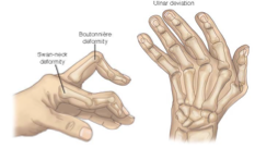 <p><mark data-color="yellow" style="background-color: yellow; color: inherit;">Chronic, systemic, autoimmune inflammatory disease characterized by</mark><span style="color: red;"><mark data-color="yellow" style="background-color: yellow; color: inherit;"> inflamm that affect daithrodial (freely moving) joints </mark></span></p><ul><li><p>commonly affect <span style="color: blue;">hands, wrist, knees </span>symmetrically </p></li></ul><p><strong><mark data-color="blue" style="background-color: blue; color: inherit;">Signs:</mark></strong><span style="color: red;"> SYMMETRICAL </span>joint pain, morning stiffness >30 min</p><p><strong><mark data-color="red" style="background-color: red; color: inherit;">Diagnostic: </mark></strong>combination (labs (ESR, CRP), radiograph/ultrasound, signs) </p><p><strong><mark data-color="purple" style="background-color: purple; color: inherit;">Tx: </mark></strong></p><ul><li><p><strong>initial: </strong>analgesic (acetam., narcotic), nsaid, glucocorticoids</p></li><li><p>if ineffective → methotrexate </p></li><li><p>surgery</p></li></ul><p><strong><mark data-color="green" style="background-color: green; color: inherit;">Care:</mark></strong></p><ul><li><p>keep up w/ vax (<span style="color: red;">NO</span> live vaccines)</p></li></ul><p></p>