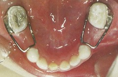 <p>can happen in primary or mixed dentition</p><p>Unilateral band/loop space maintainer</p>