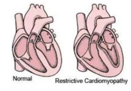 <p>Endomyocardial scarring affecting the LV and or the RV •</p><p>Restricts ventricular diastolic filling •</p><p>Marked diastolic dysfunction</p><p>(walls become stiff - not thick, have a hard time relaxig and filling ) (grade 3 diastolic dysfinction with restrictve CM)</p><p>(common to have a big atria on both the right and left side)</p>