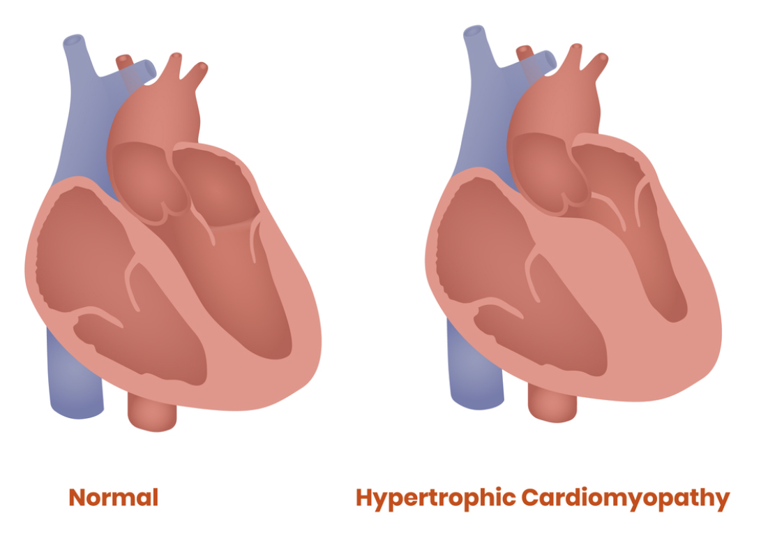 <p>Hypertrophic cardiomyopathy </p>