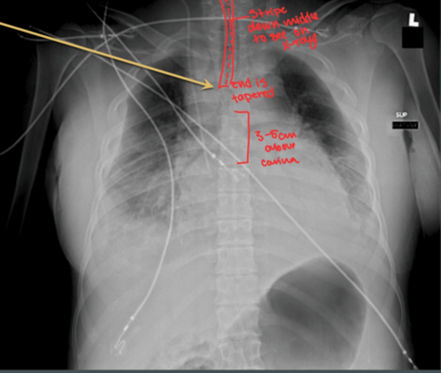 <p>goes down right lung, only that side receives air</p>