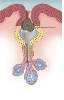 <p>sialolithiasis (salivary stones)</p>