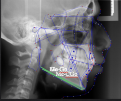 <p>which reference plane:</p><p>- Tangent line to lower border of the mandible</p><p>Three definitions:</p><p>- Me-Go</p><p>- Me-Constructed Go (This is what the American Board of Orthodontics uses)</p><p>- Go-Gn</p>