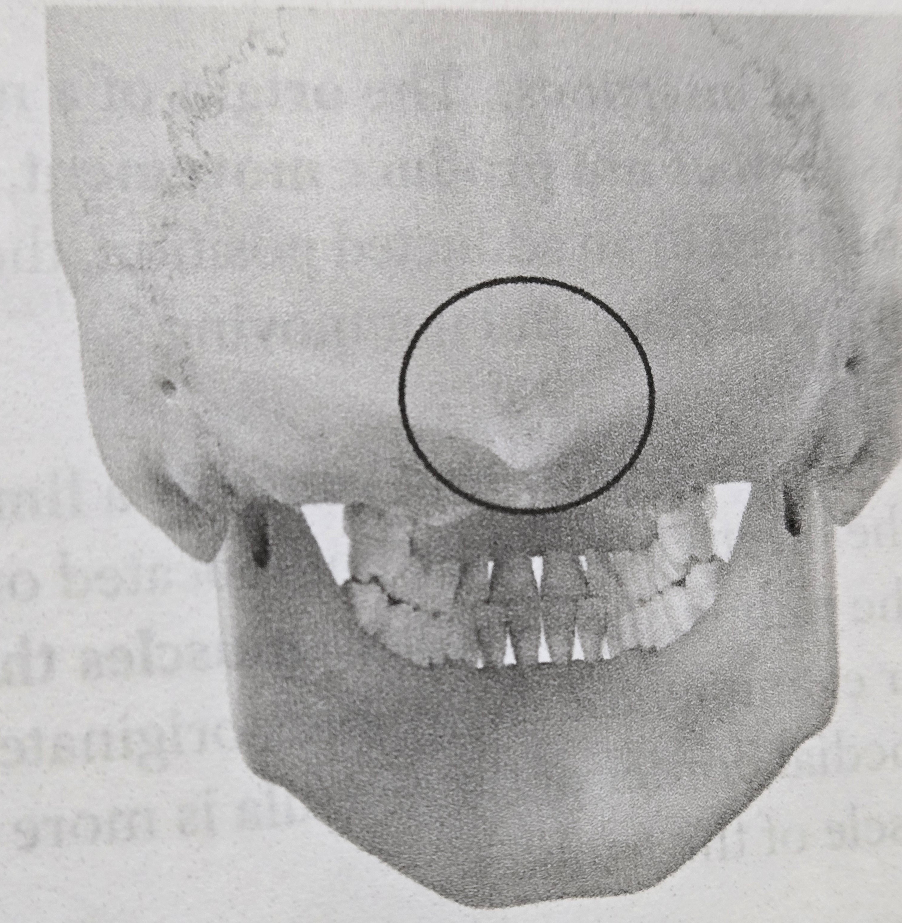 <p>Protuberance</p>