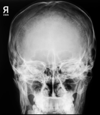 <p>PA skull demonstrates:</p>