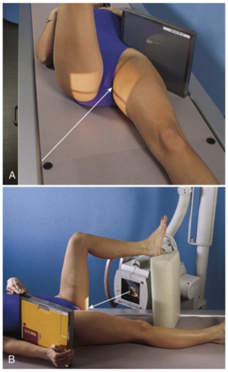 <p>S - none</p><p>T - 80 mAs @ 80 kVp</p><p>A - none</p><p>M - correct marker for correct hip</p><p>P - PT supine w/ non injured leg in stand, CR perp to mid femoral neck</p><p>S - 40"</p><p>B - suspension</p><p>C - 14 x 17 (grid cap)</p>