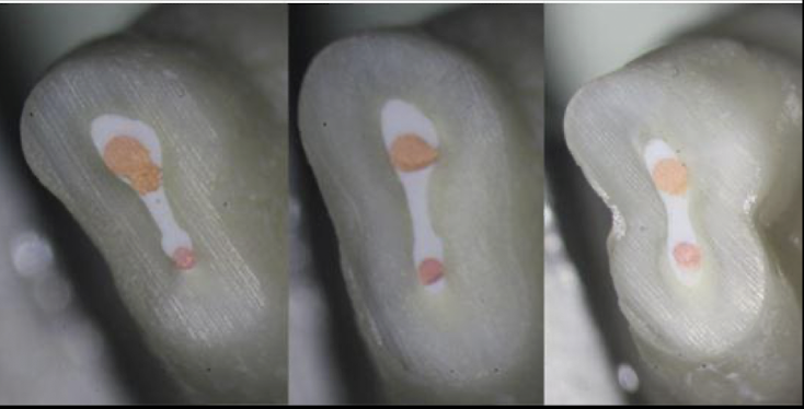 <p>hydraulic pressure to distribute the sealer (we do NOT do this technique) </p>