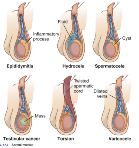 <ul><li><p>epididymitis = inflammation</p></li><li><p><strong>hydrocele = fluid</strong></p></li><li><p><strong>spermatocele = cyst</strong></p></li><li><p>testicular cancer = mass</p></li><li><p>torsion = twisted spermatic cord</p></li><li><p><strong>varicocele = dilated veins</strong></p></li></ul><p></p>