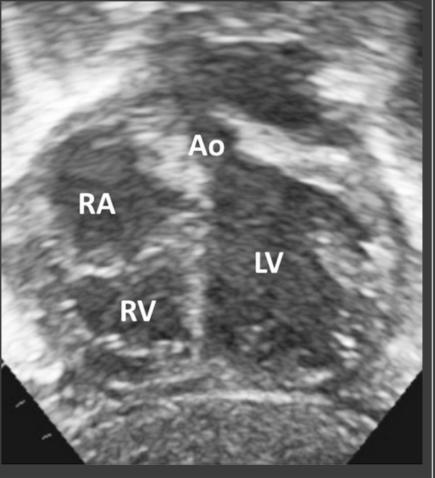 <p>what APEX AND THORACIC POSITION is this</p>