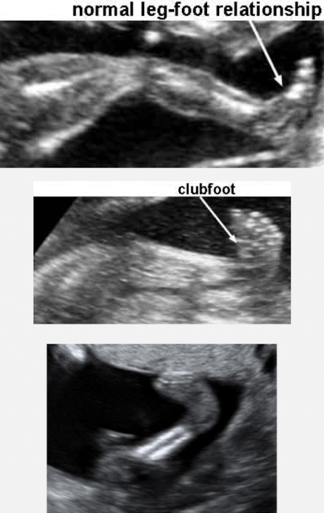<ul><li><p>malformation and/or malposition of the foot and ankle bones</p></li><li><p>aka talipes</p></li><li><p>male>female</p></li><li><p>usually unilateral</p></li><li><p>associated with a variety of chromosomal anomalies</p></li><li><p>SONO:</p><ul><li><p>persistent abnormal inversion of the foot <span style="color: red;">perpendicular</span> to lower leg</p></li></ul></li></ul><p></p>