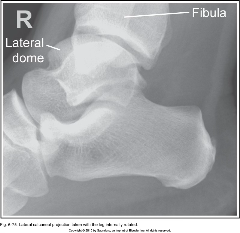 <p>lateral calcaneus</p>