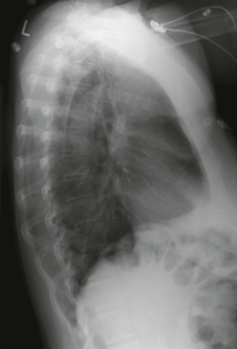 <p>Lateral Chest: Is this Image Good?</p>
