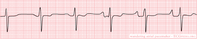 <p>Rate: <100</p><p>Regularity: irregularly irregular </p><p>At least 3 different P wave morphologies </p>