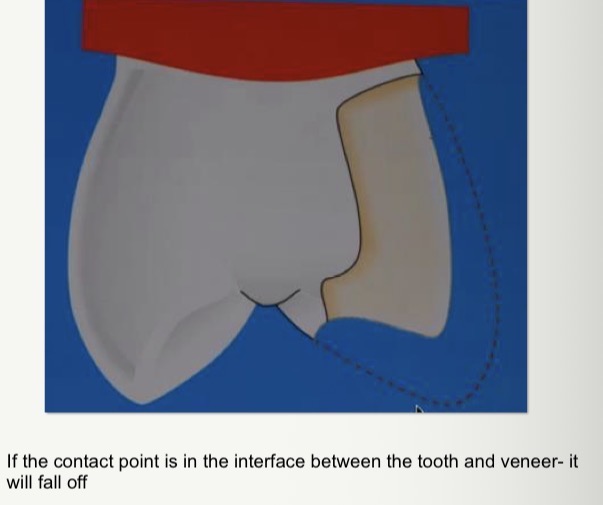 <p>Avoid positioning the contact point of the antagonist directly over the junction between the ceramic veneer and the natural tooth</p>