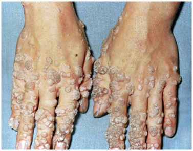 <p>Warts; spreading through direct contact to fomites</p>