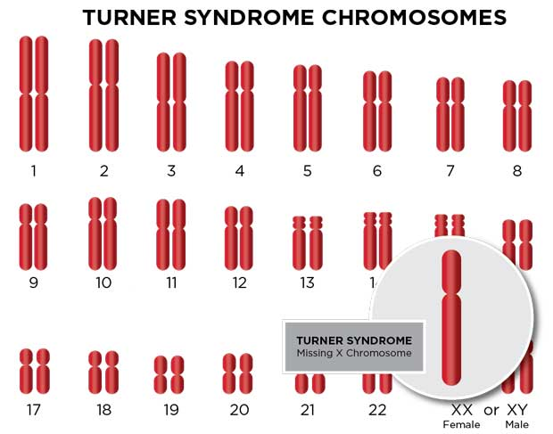 <p>If a gamete with a missing chromosome is fertilised by a normal gamete, the zygote will show monosomy:</p><ul><li><p>one chromosome copy, instead of two (e.g. Turner’s syndrome, which is X0)</p></li></ul><p></p>