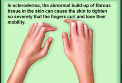 <p>Systemic scleroderma</p>