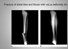 <p>Valgus</p>