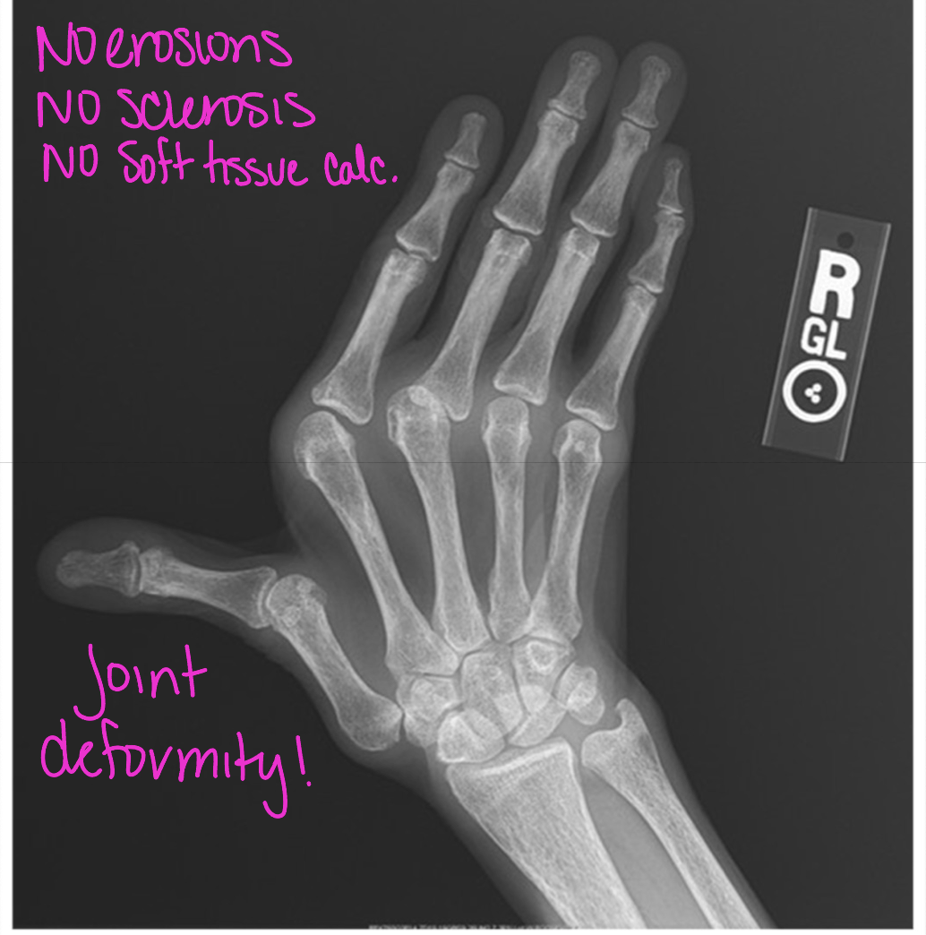 <p>What disease does this pt have </p>