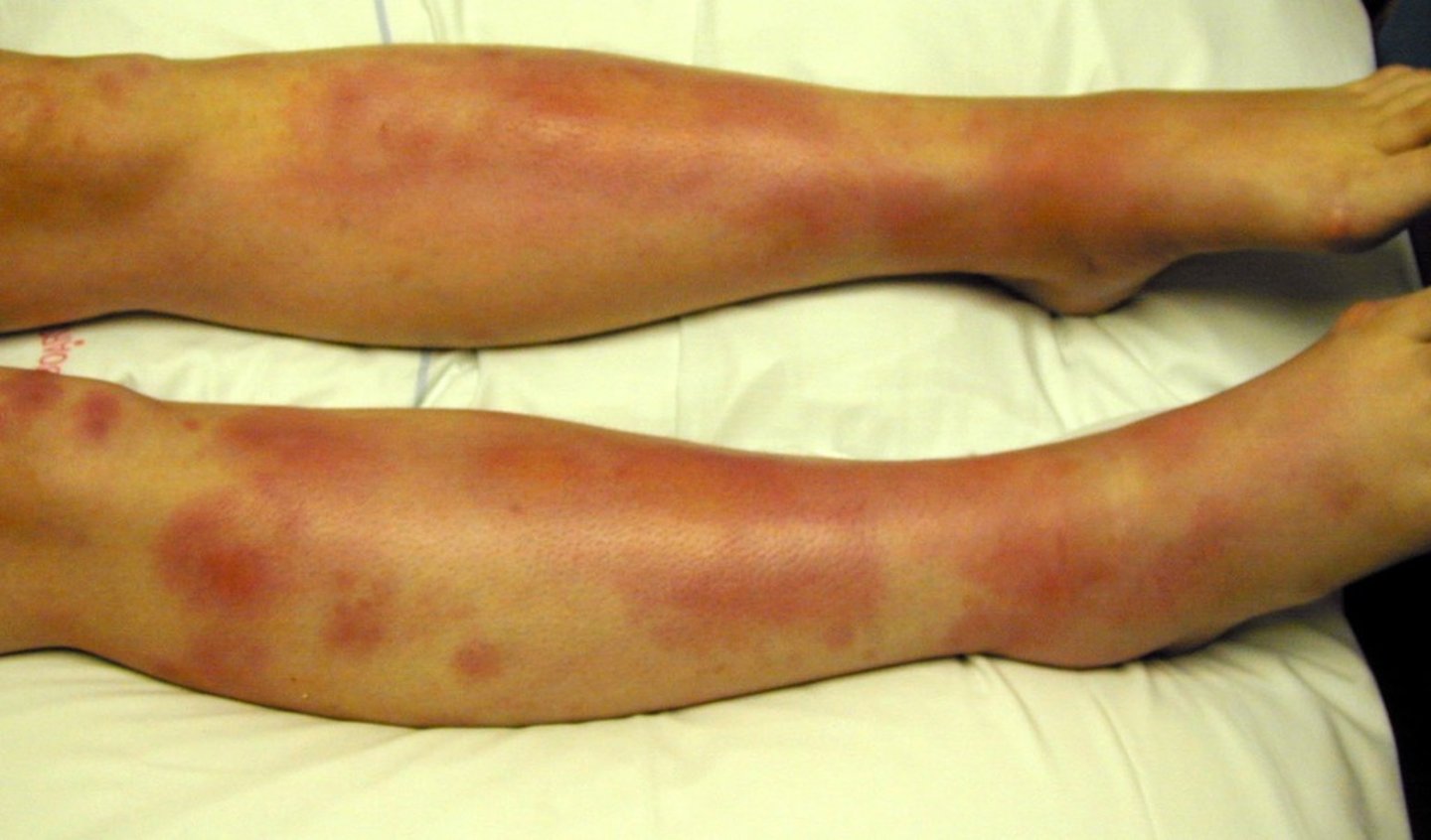 <p>redness of the skin or mucous membrane</p>