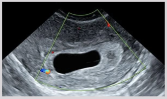 <ul><li><p><span style="background-color: transparent;">Intrauterine gestational sac is empty</span></p></li><li><p><span style="background-color: transparent;">Embryonic demise or failure of embryo to develop</span></p></li><li><p><span style="background-color: transparent;">Clinical signs:</span></p><ul><li><p><span style="background-color: transparent;">Uterus small for dates</span></p></li><li><p><span style="background-color: transparent;">Variable HCG levels</span></p></li><li><p><span style="background-color: transparent;">Vaginal spotting</span></p></li><li><p><span style="background-color: transparent;">Closed CVX</span></p></li></ul></li><li><p>US findings:</p><ul><li><p><span style="background-color: transparent;">No identifiable embryo in GS of >25 mm</span></p></li><li><p><span style="background-color: transparent;">Absence of “double sac sign” or “double decidual sign”</span></p></li></ul></li></ul><p></p>