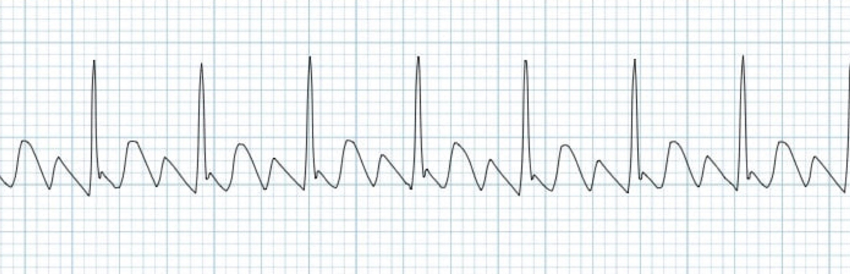 <p>What rhythm/abnormality is seen below?</p>