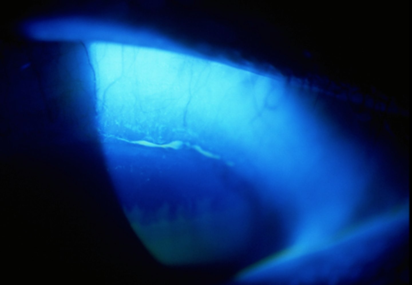<p>present parallel to the superior limbus and are due to mechanical chaffing by a contact lens on the superior cornea. The patient is usually asymptomatic.</p>