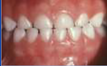 <p>primary dentition with adequate primate spacing </p>