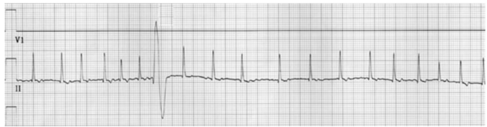 <p>This ECG is an example of ________________</p><p>(give the definition and features)</p>