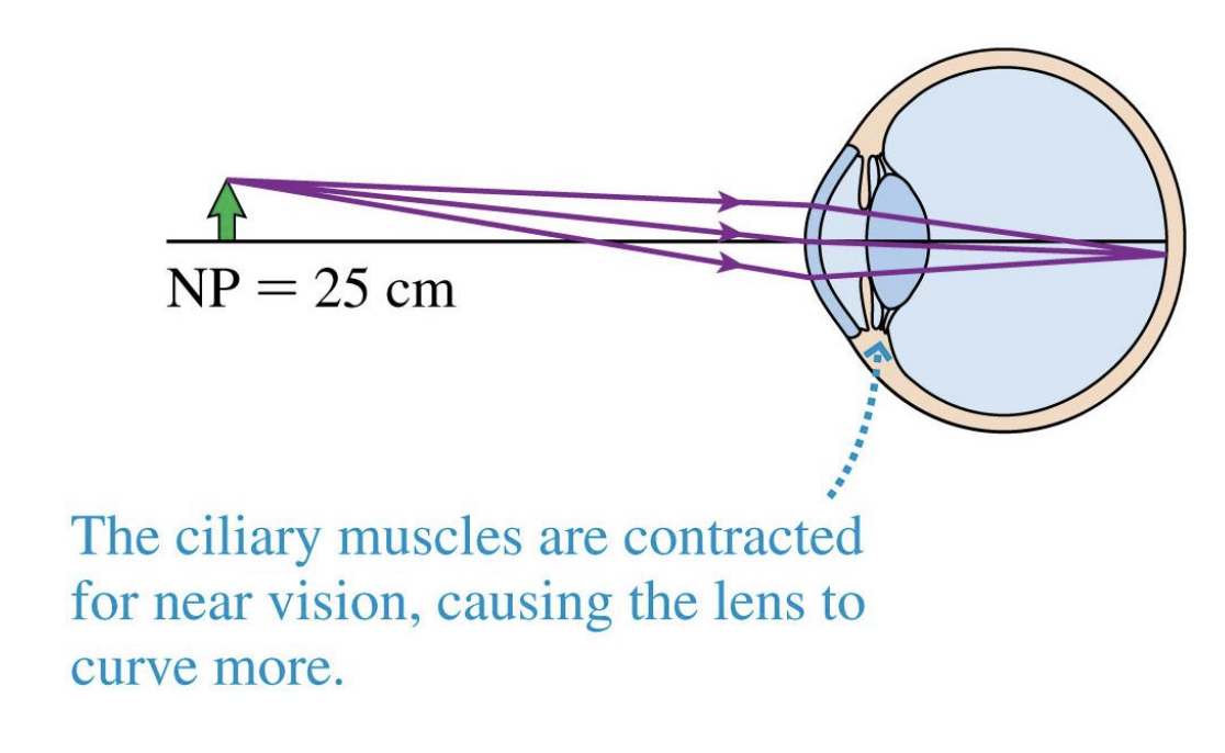 <p>-The closest distance (on average) at which a perfect eye can focus, using maximum accommodation, is the eye’s near point (NP) <mark data-color="green" style="background-color: green; color: inherit;">= 25 cm.</mark></p><p>*normal near point (NP)=infinity, far away object:s=infinity, 1/s=1/infinity=0</p><p>*closest can focus on something; ex=bring phone to phase</p>