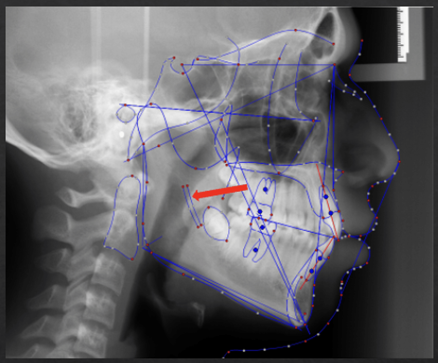 <p>which anatomical landmark:</p><p>- The inferior alveolar nerve canal</p><p>- Used to superimpose the mandible</p>
