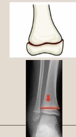 <p>Use the Salter-Harris classification system to describe the fracture pattern</p>