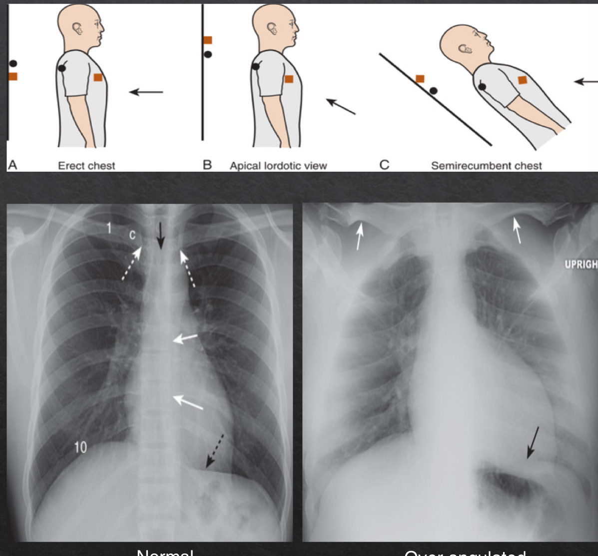 <ul><li><p>orientation of xray beam passing through object</p></li><li><p>views: </p><ul><li><p>horizontal- normal</p><ul><li><p>parallel to floor</p></li><li><p>medial end of the clavicle superimposes on 3rd or 4th rib</p></li></ul></li><li><p>over angulated </p><ul><li><p>bedridden pts that cannto fully sit up</p></li><li><p>clavicles are projected above first rib</p></li></ul></li></ul></li></ul><p></p>
