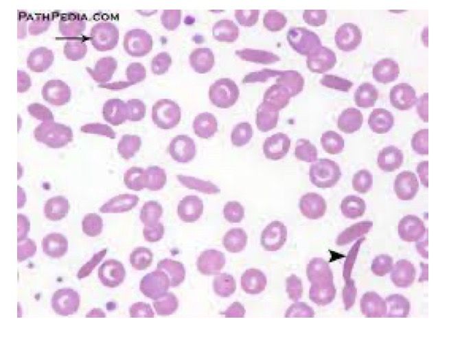 <p>What is hemoglobin S</p>