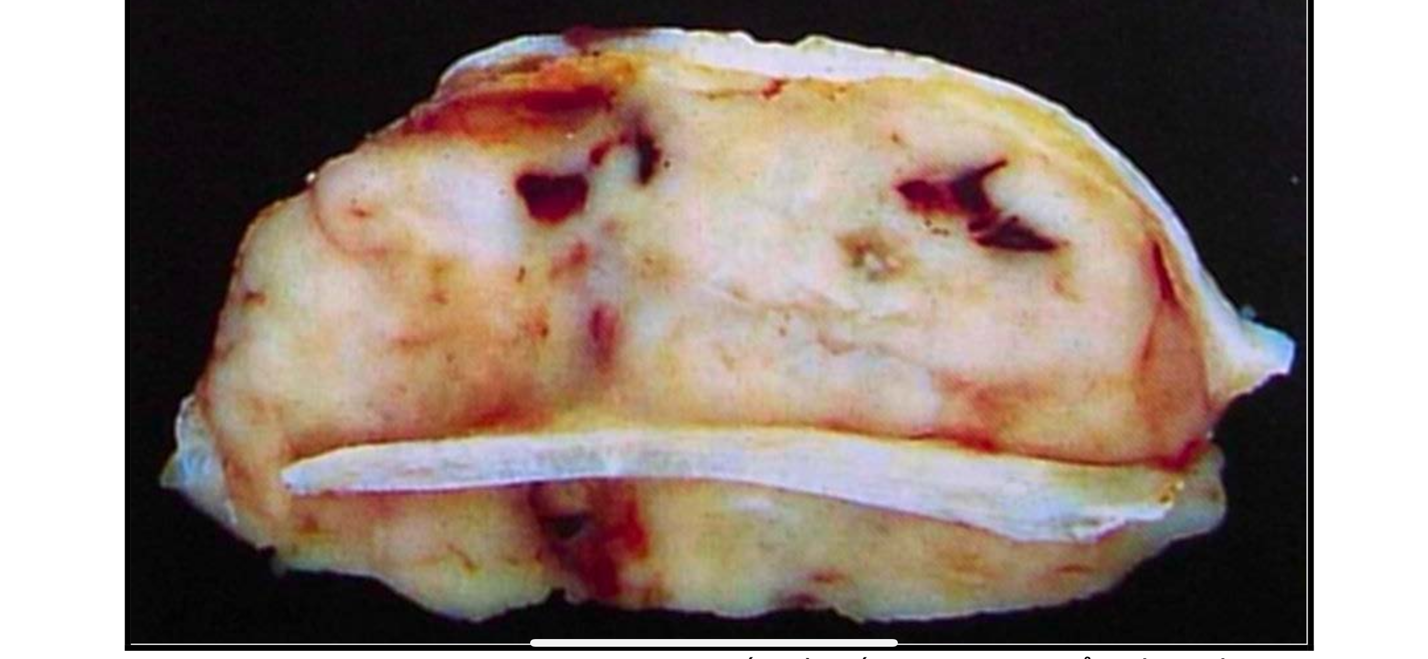 <p>Bệnh lý gì</p>