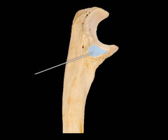 <p>*lateral</p>