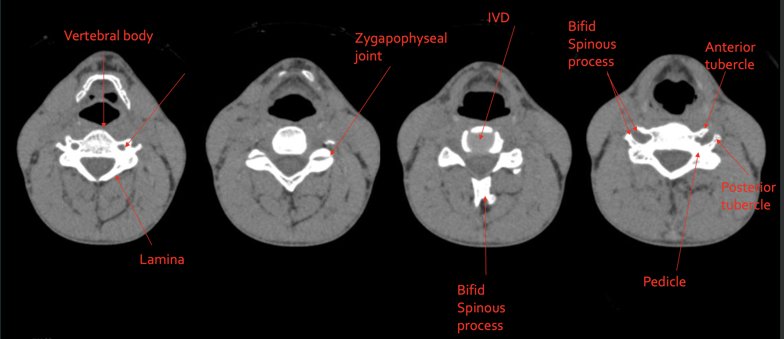 <p><strong>Posterior tubercle</strong></p>