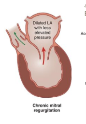 <p>What happens in acute mitral regurgitation?</p>