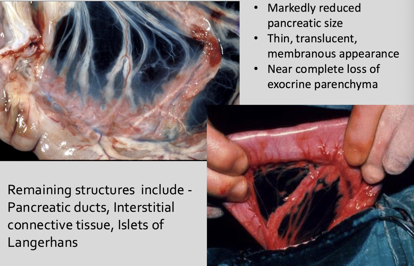 <p>markedly reduced pancreatic size, thin, translucent, membranous appearance, near complete loss of exocrine parenchyma</p>