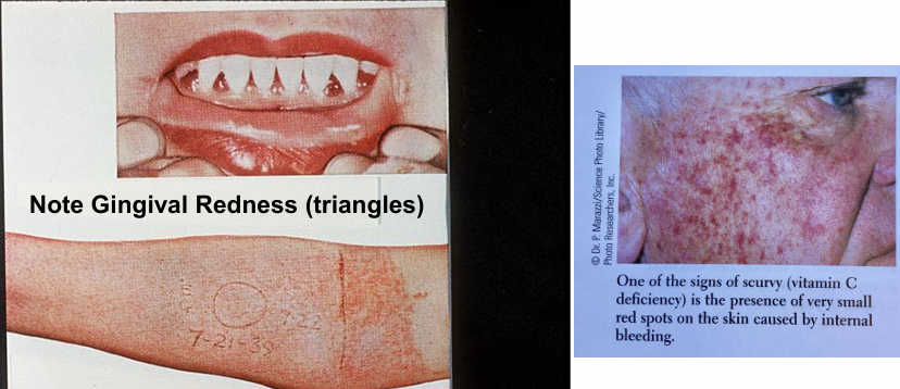 <ul><li><p><strong>scurvy</strong> </p></li><li><p><strong>poor wound healing</strong> </p></li><li><p><strong>gum lesions, spongy gums and bleeding</strong></p></li><li><p><strong>loosening of teeth</strong></p></li><li><p>scoliosis (bone matrix)</p></li><li><p>termination of bone growth </p></li><li><p>joint pain &amp; swelling </p></li><li><p>increased sensitivity in extremities</p></li><li><p>vomiting of blood &amp; bloody stools</p></li><li><p>edema of chest &amp; stomach </p></li><li><p>cerebral hemorrhage &amp; capillary fragility</p></li></ul><p></p>