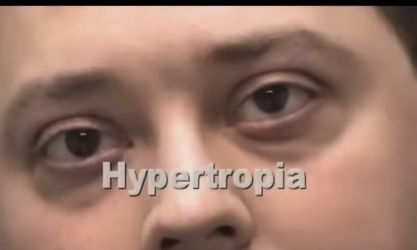 <p>hypertropia</p>