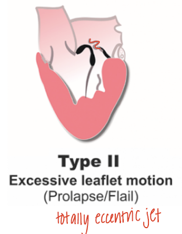 <ul><li><p>Occurs because of leaflet prolapse due to <strong>simple elongation of the leaflet </strong>or<strong> flail leaflet</strong> due to chordal /PM rupture</p></li></ul><ul><li><p>MR jet is <strong>eccentric</strong></p></li></ul><p></p>
