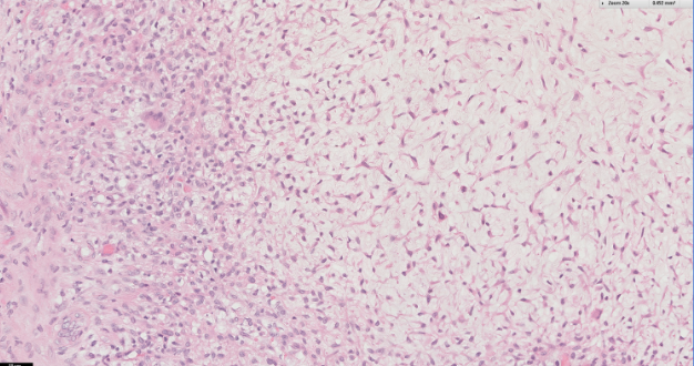 <p>Tumeur homme de 20 ans, fémur, métaphyse </p><p>diagnostic</p><p>définition</p><p>age</p><p>topographie</p><p>anatomie</p><p>histologie</p><p>moléculaire</p>