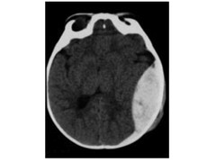 <p>temporal bone fx</p>