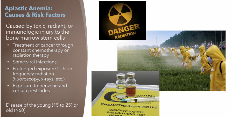 <p>Caused by toxic, radiant or immunologic injury to the bone marrow stem cells</p><ul><li><p>Diagnosed via bone marrow biopsy </p><ul><li><p>10-15% of severe aplastic anemia cases evolve into myelodysplastic syndrome and leukemia</p></li></ul></li></ul><p></p>
